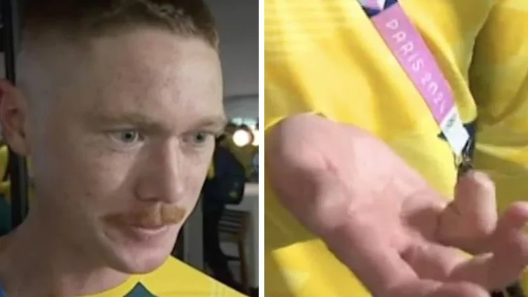 Olympic Athlete Chooses Finger Amputation to Compete in Paris Games