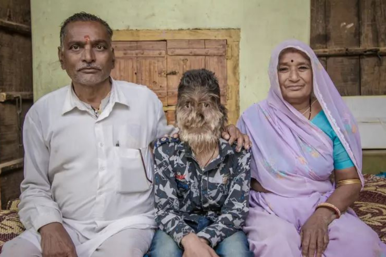 Indian teen gets bullied over rare “werewolf syndrome”