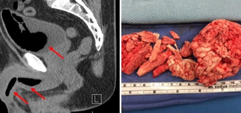 Man May Never Use His Penis Again After Partner Deploys Insulation Foam into His Urethra