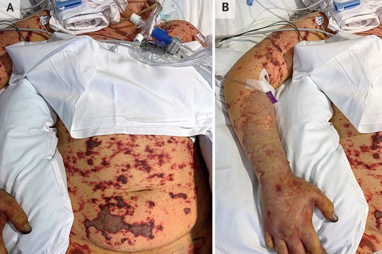 Teen Has Legs Amputated After Leftover Noodles Trigger Deadly Condition