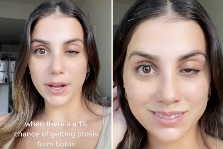 Botched Botox Injection Causes Patient Not Be Able to Open One of Her Eyes
