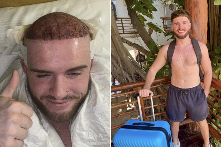TikTok Superstar Forced Into Celibacy Following Hair Transplant Surgery