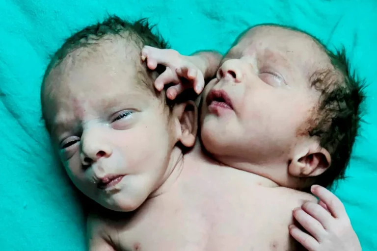 Miracle Baby Born with 2 Heads, 3 Hands Leaves Doctors Stunned