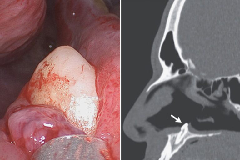 Man was having a hard time breathing, turns out he had a tooth growing in his nose